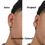Perfil de oreja mostrando antes y después del uso de corrector semitransparente discreto para una corrección estética natural.