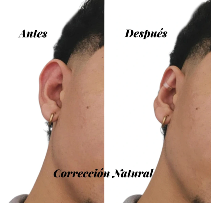 Perfil de oreja mostrando antes y después del uso de corrector semitransparente discreto para una corrección estética natural.