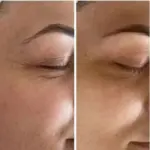 Antes y después del contorno de ojos Tensorix antiarrugas mostrando menor visibilidad de patas de gallo y piel hidratada.