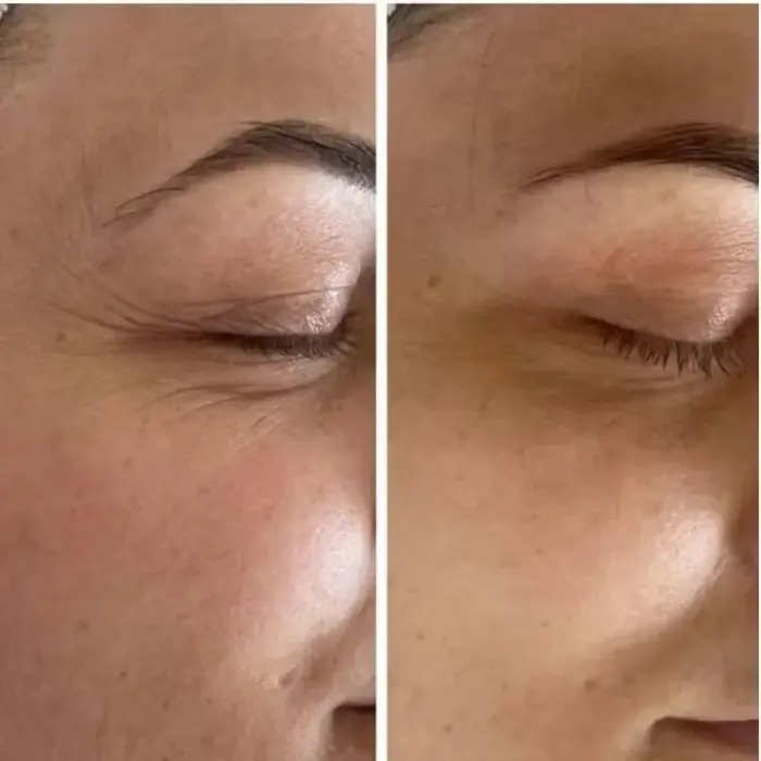 Antes y después del contorno de ojos Tensorix antiarrugas mostrando menor visibilidad de patas de gallo y piel hidratada.