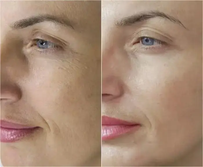 Comparativa de antes y después en el contorno de ojos: piel con líneas de expresión frente a piel visiblemente más lisa, tersa e hidratada.