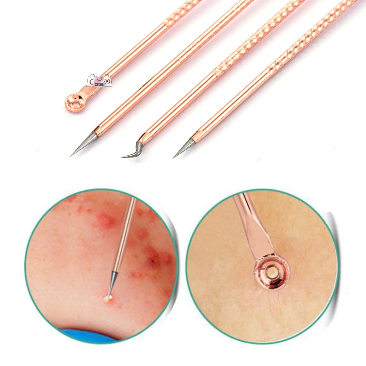 Extractores de acné color oro rosa con puntas de lazo, gancho y aguja, con acercamientos de su aplicación sobre la piel.