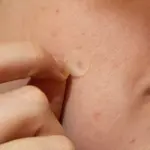 Dedo retirando un parche hidrocoloide transparente y redondo para imperfecciones de la piel sobre el rostro.
