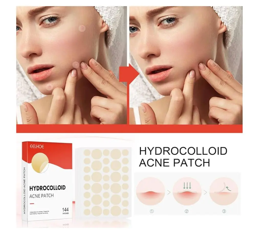 Caja roja de parches hidrocoloides para acné con hojas de 144 unidades redondas y modelo mostrando su uso en el rostro.