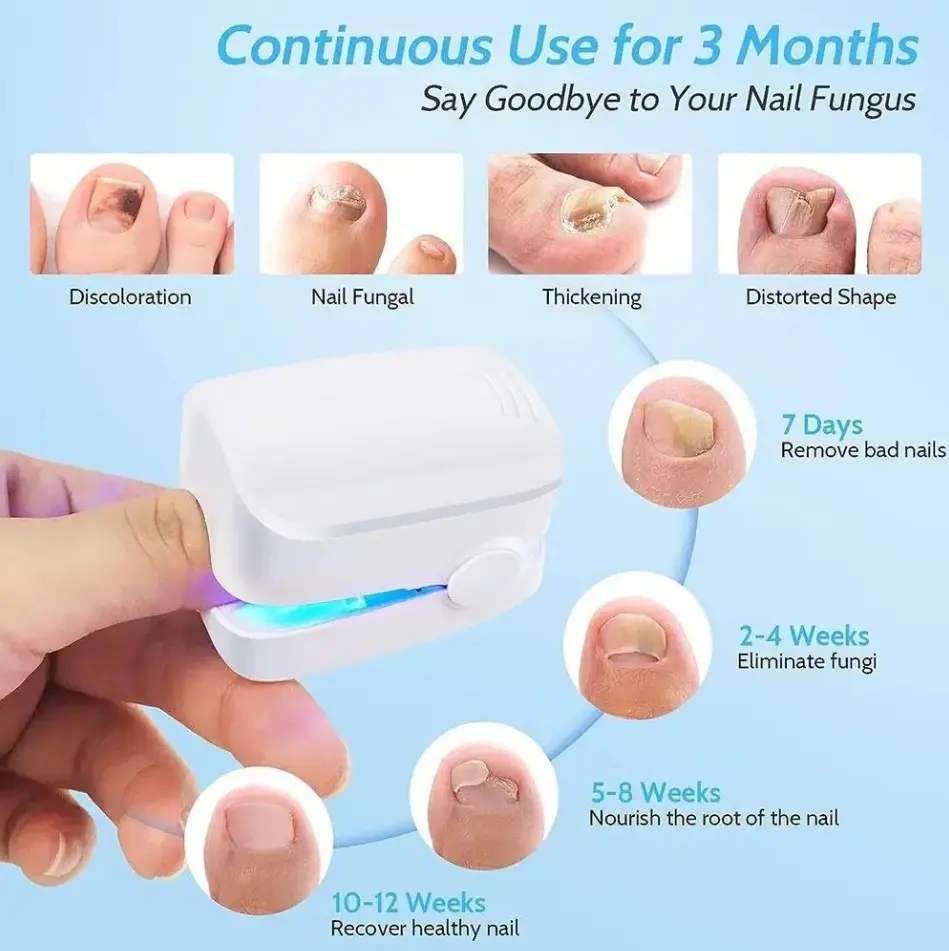 Dispositivo blanco portátil para fototerapia en uñas con luz azul, diseñado para tratar hongos en manos y pies mediante uso continuo.